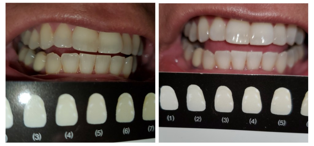 Fairywill Teeth Whitening Strips Before and After