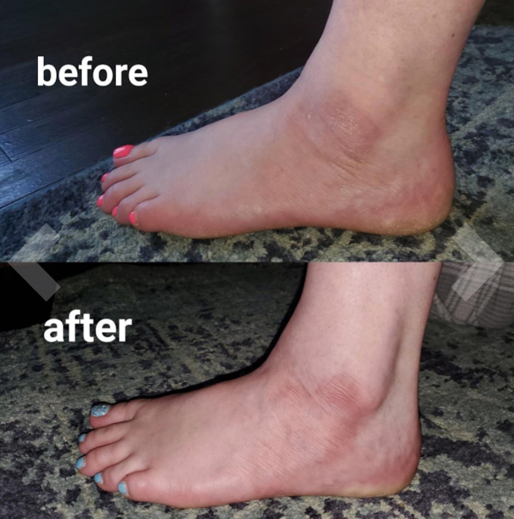before and after of dry winter cracked skin feet