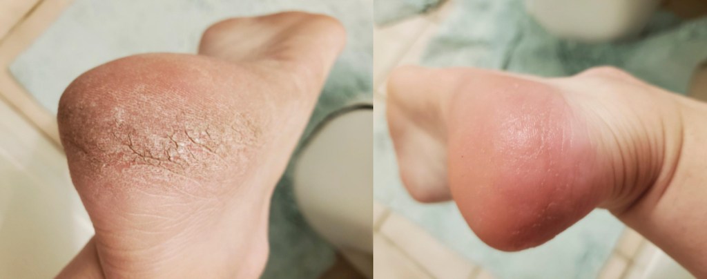 before and after of dry cracked feet dry feet remedies