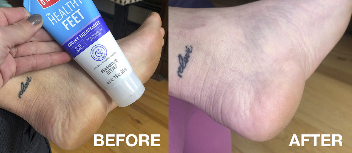 Dry Feet \u0026 Cracked Skin Remedies 