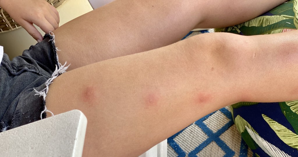 mosquito bites on a child