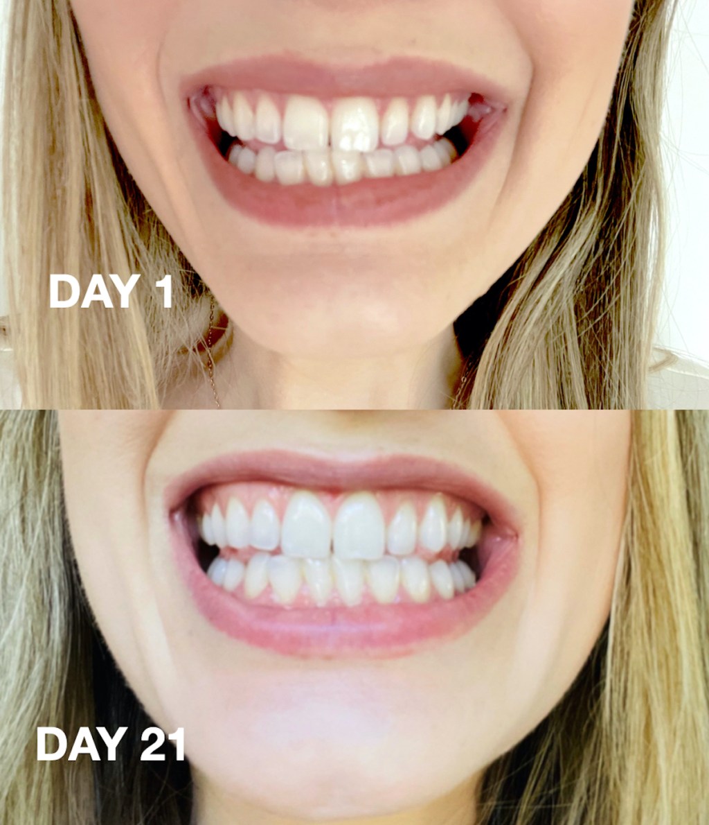 8 Easy Facts About Smirk Teeth Whitening Strips Described