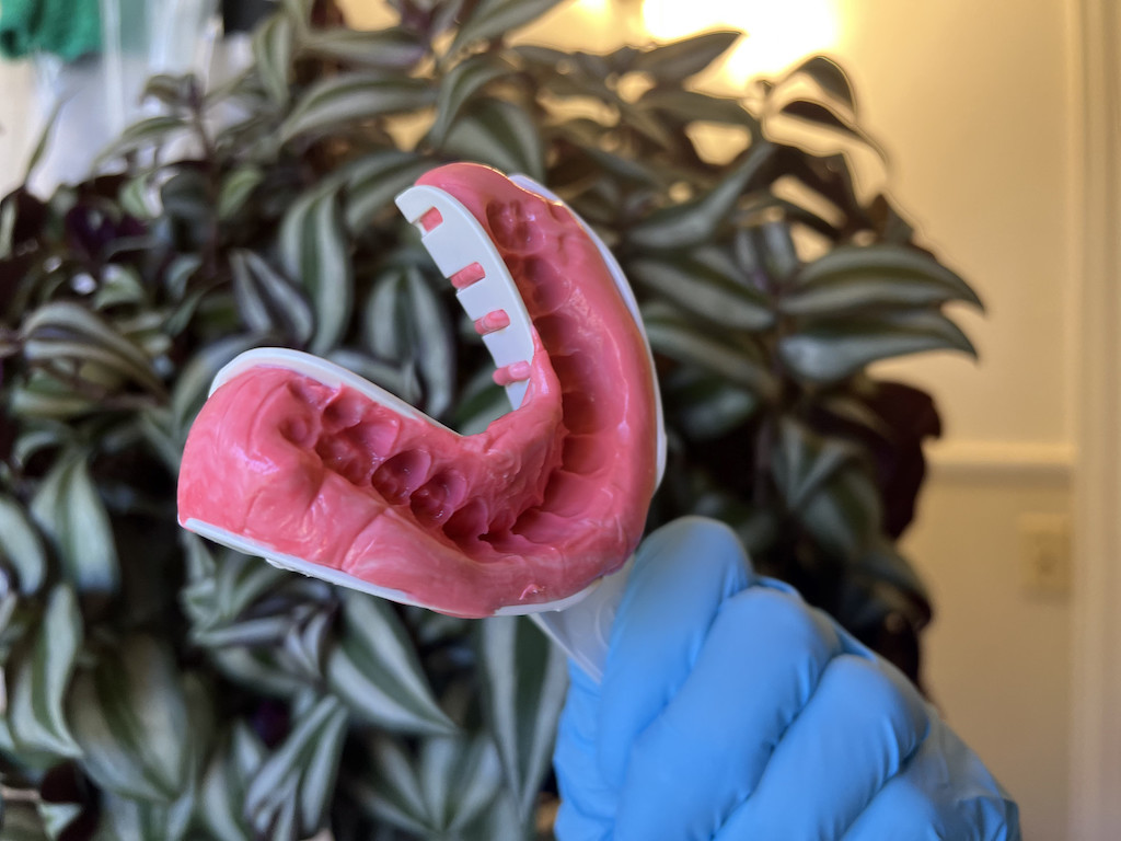 holding up teeth impression tray with putty inside 