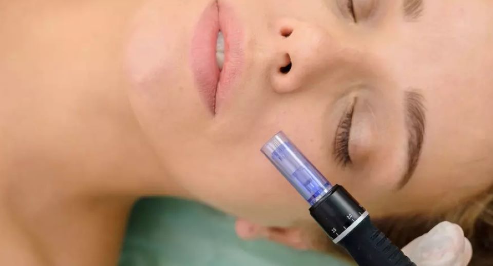 Person microneedling another person face