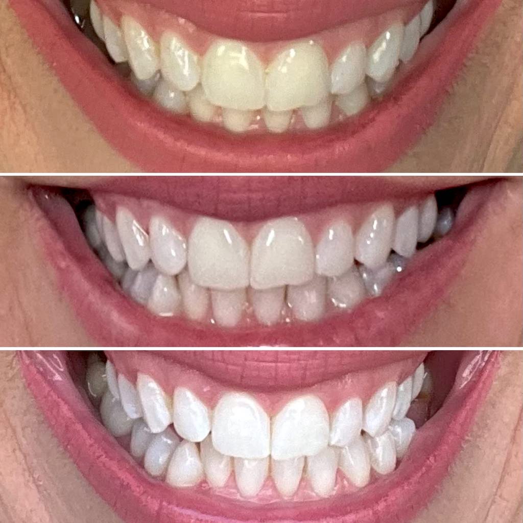 Before and after teeth whitening 