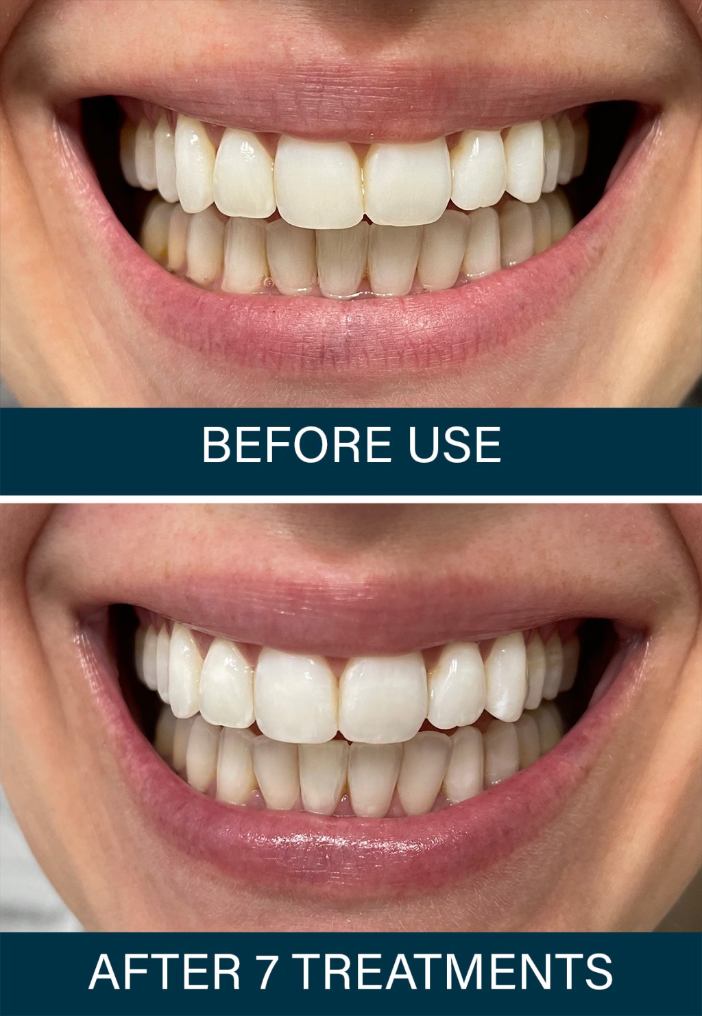 lumineux before and after using whitening strips
