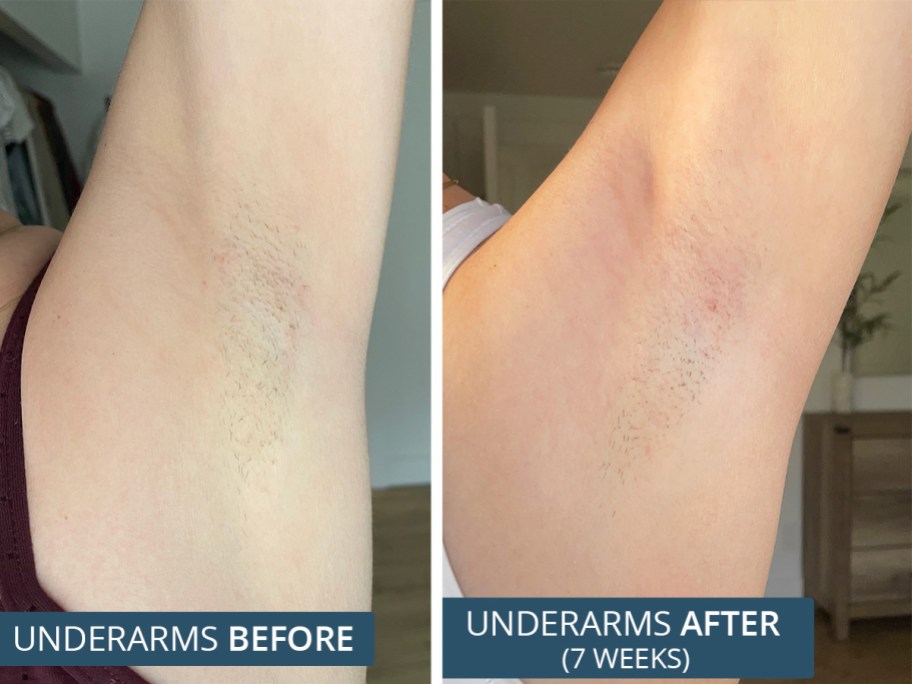before and after of armpit hair removal