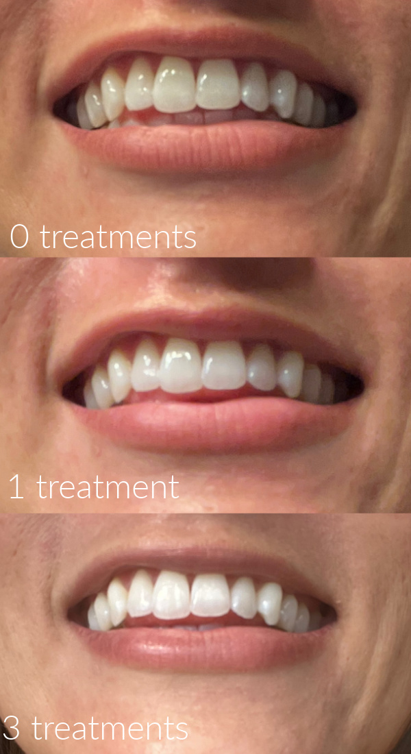 before and after shots from using teeth whitening strips